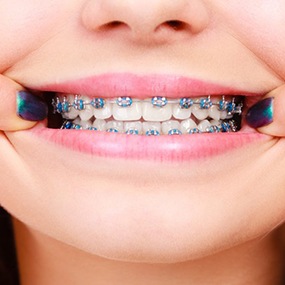 Woman pulling her lips back to reveal braces with blue elastics 