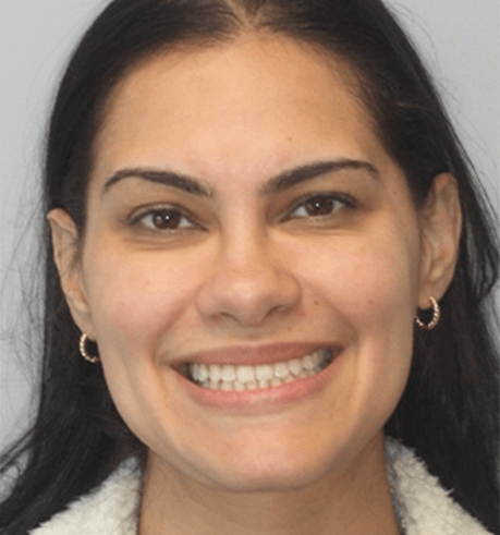Young woman smiling with perfectly straight teeth