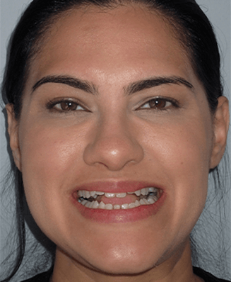 Young woman smiling with several misaligned teeth