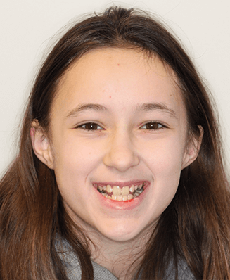 Teenage girl smiling with misaligned teeth