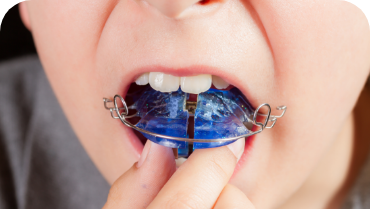 Person placing a retainer in their mouth