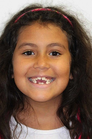 Young girl smiling with severely misaligned teeth