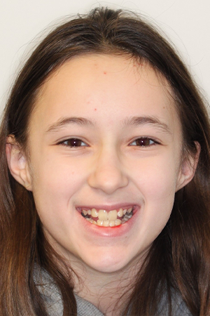 Teenage girl smiling with crowded and crooked teeth
