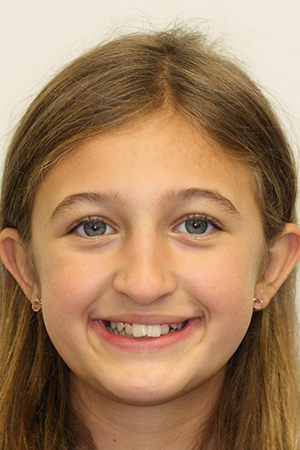 Teenage girl smiling with misaligned teeth