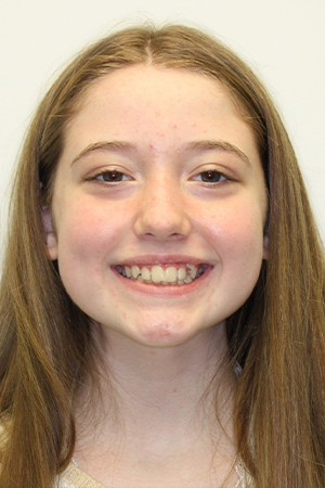 Smiling young woman with misaligned teeth