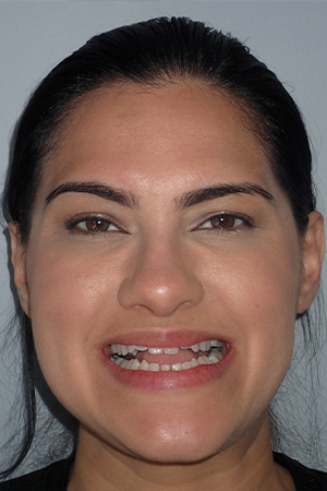 Woman smiling with misaligned teeth