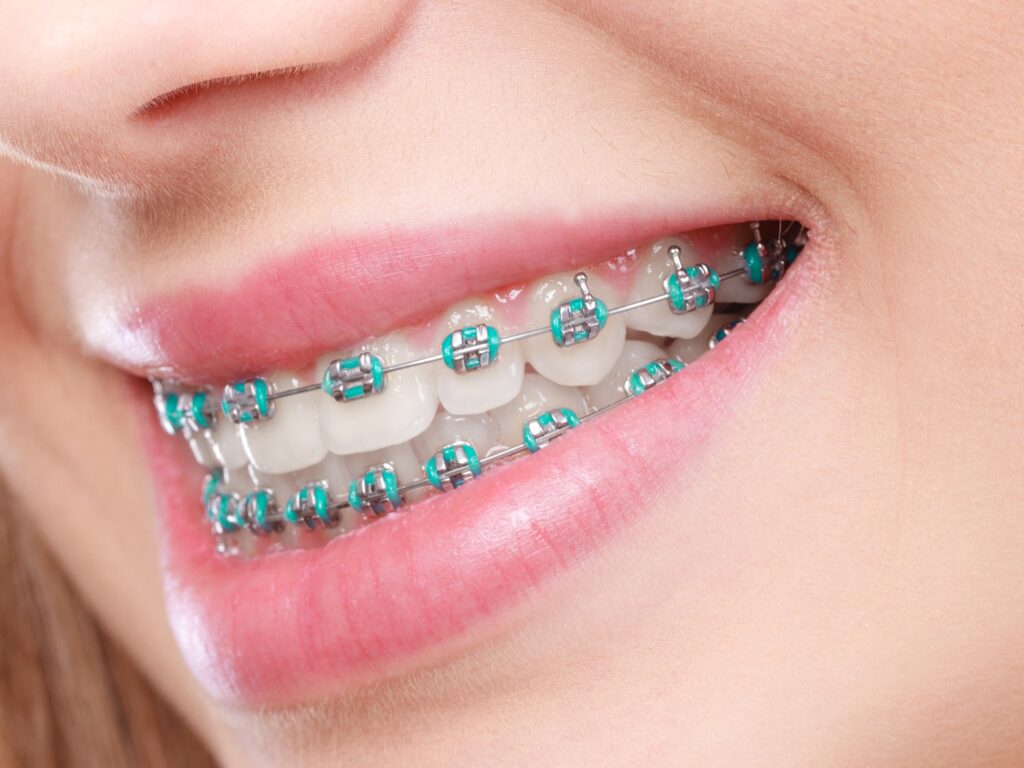 Closeup of braces 