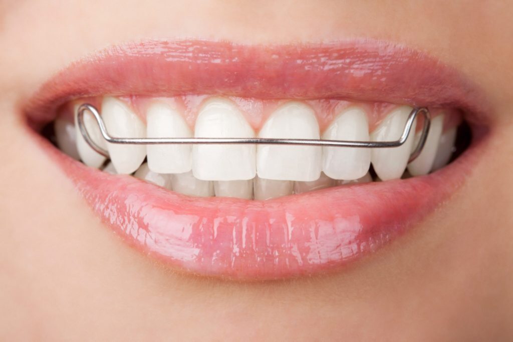 Closeup of woman smiling while wearing retainer 