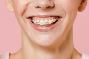 a patient with clear braces smiling