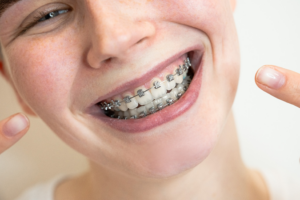 a patient with traditional braces smiling