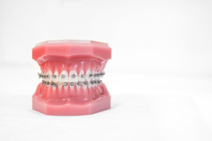 a teeth model with braces