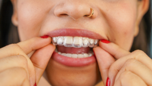 a patient holding their Invisalign aligner