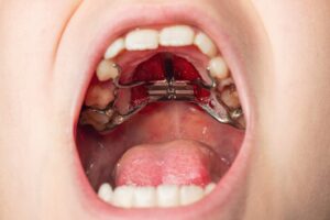 Up-close image of a palatal expander